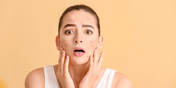 Acne Treatment in Sonipat