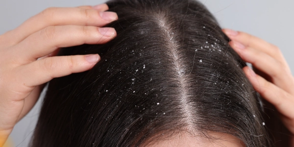 Dandruff & Scalp Treatments
