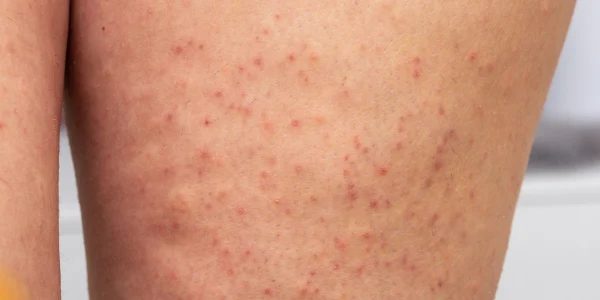 Ingrown Hair & Razor Bump Treatment