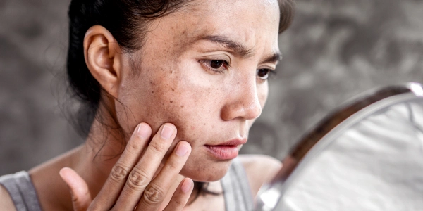 Pigmentation Treatment