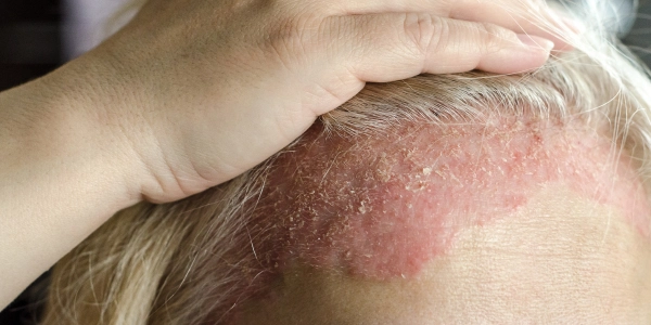Seborrheic Dermatitis Treatment in sonipat
