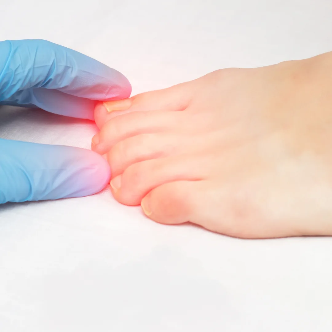 Ingrown Toenail Solutions